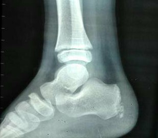 Radiografía talón enfermedad de Sever